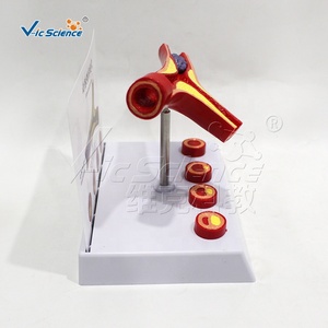 Modelo 3D de Congestión Vascular Bifurcada / Comparación de Estasis Venosa/Arterial por Edad, Entrenamiento de Simulación Médica, Alerta de Riesgo CVD - Product Image 4