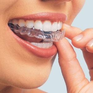 Oral Hygiene Thermoforming Dental Mouthguard Multi-Purpose <b>Teeth</b> <b>Whitening</b> Accessories Including <b>Teeth</b> <b>Whitening</b> <b>Tooth</b> Whitener - Product Image 5