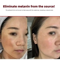 Ensemble de soins de la peau éclaircissants pour le visage à la vitamine C, 3 pièces, sérum et crème, éliminateur de taches brunes, correcteur de pigmentation, meilleur ensemble éclaircissant pour la peau