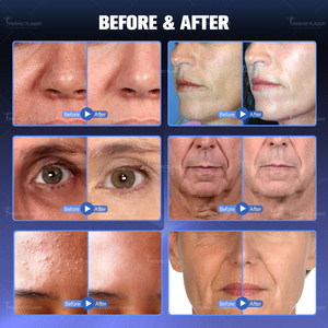 Appareil d'hydrodermabrasion multifonctionnel Perfectlaser, élimination des points noirs, resserrement des pores, machine de soin de la peau du visage - Product Image 5