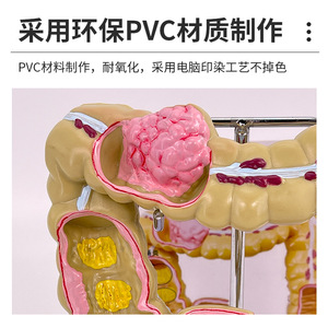 Modèle de simulation pédagogique de la pathologie du côlon, spécimen de lésion colorectale, communication médecin-patient sur les intestins, organe humain - Product Image 3