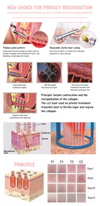 Máquina de Belleza con Láser Fraccional de CO2, Dispositivo de Corte con Láser de CO2, Láser Fraccional para Cicatrices de Acné, Pecas, Arrugas, Estrías - Product Image 6