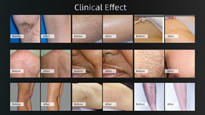 أحدث جهاز إزالة الشعر بالليزر ثلاثي الموجة 2026 بتقنية الديود 808 نانومتر 755 808 1064 للصالونات - Product Image 3