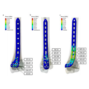 Implantes Ortopédicos Quirúrgicos Manuales de Titanio para Tibia Distal, con Bloqueo Intramedular Multidimensional, Eficaz para Traumatismos - Product Image 2