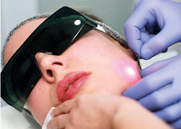 Serat Fiber Sekali Pakai 25cm Khusus untuk Wajah Endolift Laser, Satu Serat untuk Satu Pasien