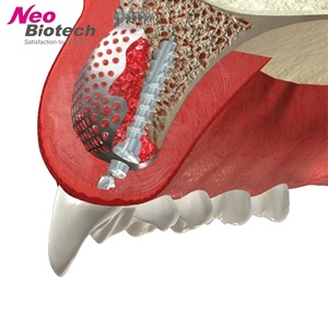 Kit GBR per Impianti Dentali Neobiotech, Kit di Rigenerazione Ossea Guidata per Chirurgia Implantare, Kit <span class=keywords><strong>EZ</strong></span>-GBR Originale per Strumenti Dentali Ospedalieri - Product Image 4