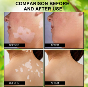 Ungüento para Eliminar Efectivamente el Vitiligo, Elimina la Tiña y las Manchas Blancas, Producto para el Cuidado de la Piel con Vitiligo - Product Image 4