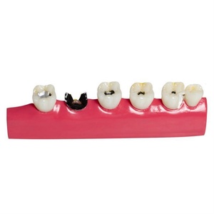 Modelos de enseñanza dental Clasificación de caries de resina y PVC y modelos de educación oral para entrenamiento - Product Image 6