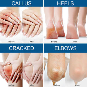 Beste Voeten Handverzorging Exfoliatie Dode Huid Verwijderen Callus 40% Ureum Gebarsten Hielherstelcrème Vochtinbrengende Voetcrème - Product Image 2