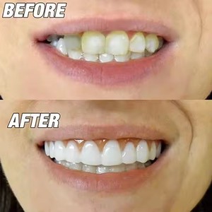 Fausses dents supérieures/inférieures en silicone Facettes de rire parfaites Pâte dentaire Outils d'hygiène buccale Dents Sourire Dents Cosmétique - Product Image 4