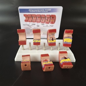 Model Anatomi Aterosklerosis Manusia, Penyumbatan Patologis Intima, Stenosis, Akumulasi Lemak, Jantung Lansia Paruh Baya - Product Image 4