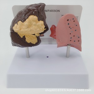 Modèle de comparaison des poumons sains et des poumons pathologiques ; Comparaison des poumons normaux et des poumons pathologiques ; Section anatomique de - Product Image 4