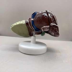Modèle de Pathologie du Cancer du Foie avec Base - Spécimen Pédagogique d'Hépatologie - Product Image 2