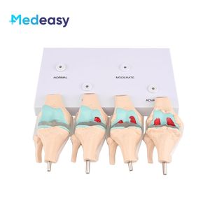 Levensgroot 4-fasen kniegewrichtsmodel Pathologisch anatomisch <span class=keywords><strong>model</strong></span> Schadewaardigheidsdemonstratiemodel Osteoartritismodel voor onderwijs - Product Image 3