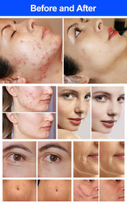 เครื่องเลเซอร์ CO2 แบบพกพา รุ่นยอดนิยม 10600nm สำหรับกระชับและตัดผิว พร้อมการรับประกัน 1 ปี - Product Image 6