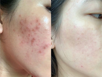 Espículas de Esponja Cosméticas, Extracto de Esponja Hidrolizada en Polvo, Bio Microneedling, Peeling Natural de Algas, 2024G