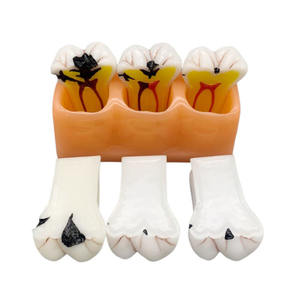 Modèle de classification de la carie dentaire quadruple Science médicale Maladie de la carie dentaire - Product Image 3