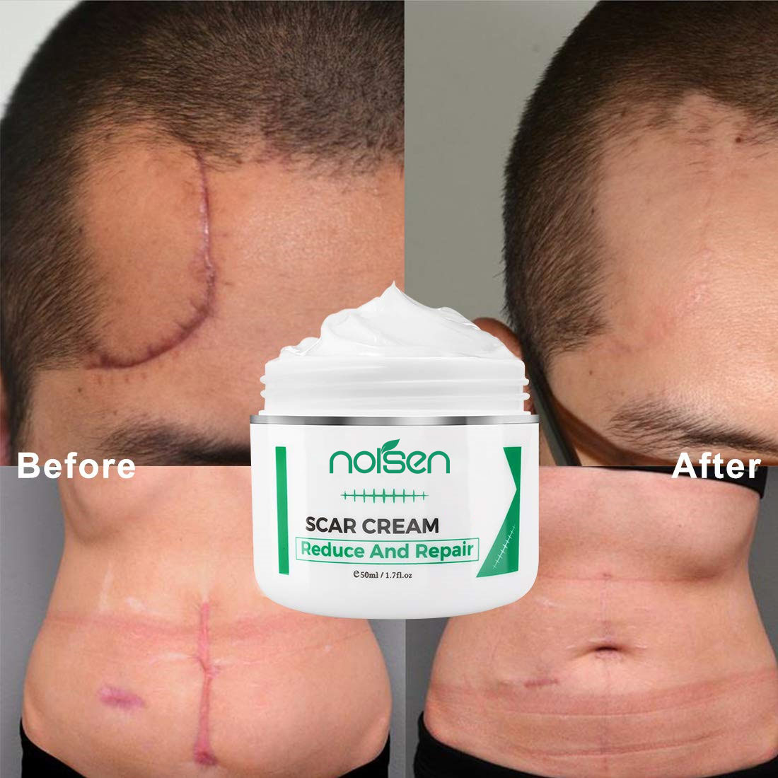 Hot Selling Acne Scar Stretch Marks Remover Cream Skin Repair Face Cream Acne Spots Acne Treatment korea Whitening Cream
