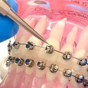 Nouveaux Appareils Orthodontiques Chinois Tiantian 2026, Produits Orthodontiques, Matériel Dentaire, Appareils Auto-Ligaturants - Product Image 6