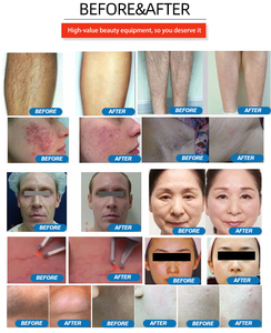 <span class=keywords><strong>Taibo</strong></span> Beauty - Precio Especial - Máquina de Depilación Láser de Pulso Largo para Tratamiento de Acné, Vascularización y Melasma, Rejuvenecimiento de la Piel, Dispositivo de Belleza 2026 - Product Image 5