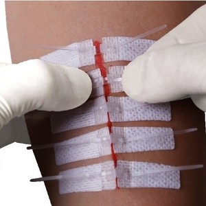 Cinta Quirúrgica Adhesiva Transparente de un Solo Uso Medco, Sin Suturas, para Cesárea - Product Image 2