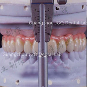 Support d'implant Restaurations dentaires Pont <span class=keywords><strong>en</strong></span> <span class=keywords><strong>zircone</strong></span> vissé avec barre <span class=keywords><strong>en</strong></span> titane Laboratoire <span class=keywords><strong>dentaire</strong></span> chinois - Product Image 4