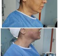 Appareil laser à diode Fiberlift 1470 nm, machine laser lipo, liposuccion Vaser, lipolyse, raffermissement de la peau, appareil laser endolaser, lifting