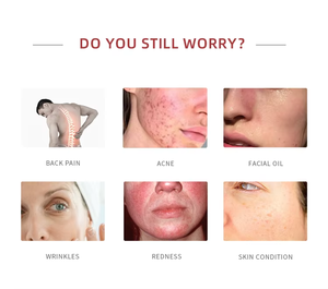 Équipement de beauté anti-taches de rousseur, anti-taches de naissance et anti-taches de vieillissement, vente chaude 2024 - Product Image 6