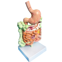 Modelo patológico de intestino grueso, lesiones gastrointestinales, modelo anatómico, enfermedad intestinal, modelo de lesiones de colon humano