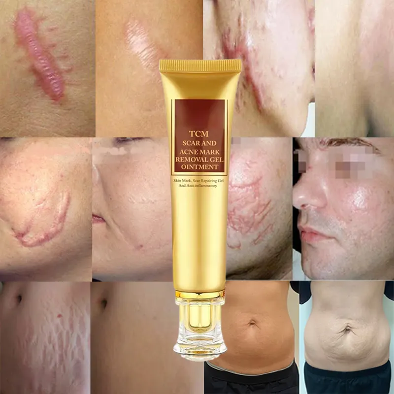 make your own logo acne marks scars remover,oem woman stretch mark cream,body pimples scars removal cream