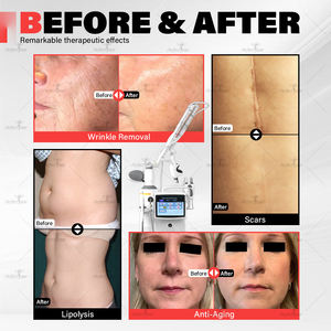 2025 Venta caliente Fotona 4d Rejuvenecimiento Láser Máquina de estiramiento de la piel Precio Médico Vaginal Estiramiento 1064nm Fraccional Co2 Láser - Product Image 6