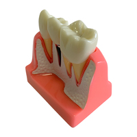 Modèle d'implant dentaire pour la démonstration patiente Modèle de couronne et de pont d'implant dentaire