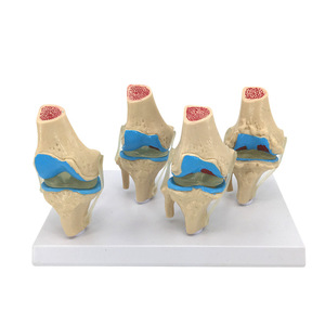 Modelo patológico humano de articulación de rodilla; lesiones; articulación de rodilla degenerativa/enfermedad; comunicación sobre cirugía artroscópica. - Product Image 1