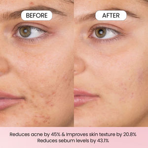 Mousse Nettoyante Visage Contrôle Sébum à <span class=keywords><strong>l</strong></span>'<span class=keywords><strong>Acide</strong></span> <span class=keywords><strong>Salicylique</strong></span>, Hamamélis et Niacinamide Marque Blanche – Soin Nettoyant Moussant pour le Visage - Product Image 6