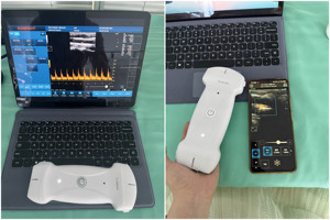 Sunbright Wireless USB <strong>Linear</strong>/Convex/Phased <strong>Array</strong> Probe Pocket Color Doppler Ultrasound Scanner - Product Image 5