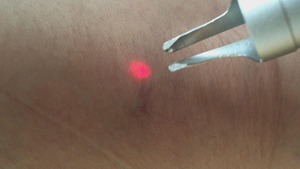 Élimination portable des varices et des télangiectasies au laser 980nm/1470nm – Traitement des capillaires et des angiomes de la <span class=keywords><strong>cerise</strong></span> - Product Image 5