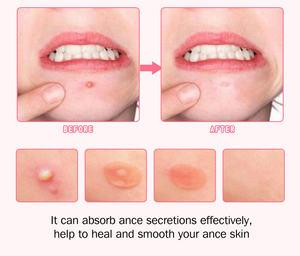 แผ่นแปะสิวไฮโดรคอลลอยด์แบบใส ยี่ห้อสินค้าของลูกค้า (Private Label) รับผลิตแบบ OEM ปริมาณขั้นต่ำน้อย ผสมทีทรีออยล์และกรดซาลิไซลิก สำหรับสิวอักเสบและสิวผดผื่น - Product Image 4