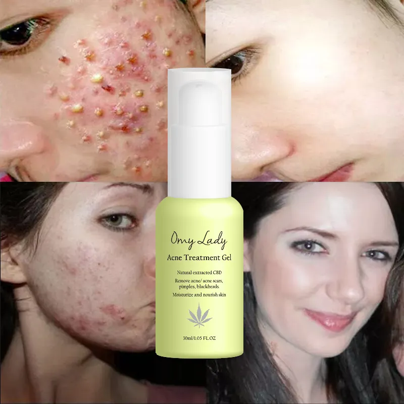 OMY LADY Wholesale Anti Acne Facial Skin Face Acne Scar Removal Cream