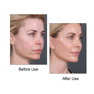 <strong>Face</strong> Slimming Bandage V Line <strong>Face</strong> <strong>Shaper</strong> Lifting up Belt for Thin Chin Cheek - Product Image 4
