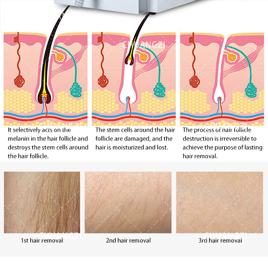 CE Portable 3 Wavelength Diode Laser Pubic Hair Removal Machine 755nm