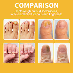 2025 Popular Método de uso simple Recuperación rápida de la salud de las uñas Crema reparadora de uñas dañadas - Product Image 3