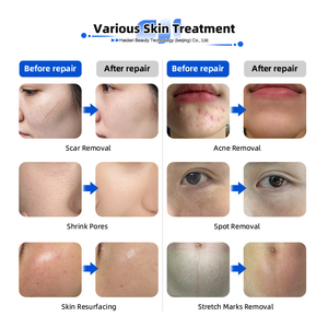 Équipement de salon de beauté de haute qualité pour le resurfaçage de la peau, l'élimination des verrues et la régénération, laser fractionné CO2 10600nm - Product Image 4