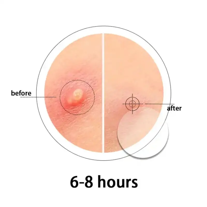 מותג פרטי מקורי טבעוני וברכזיות חינם מדבקות לטיפול נקודתי כיסוי נקודה בלתי נראית הידרוקולואיד תיקון פצעונים אקנה