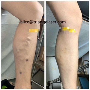 Máquina de Tratamiento de Venas Varicosas con Láser de Diodo de 980nm, Dispositivo de Eliminación Vascular de Arañas Vasculares con Láser de 1470nm - Product Image 5
