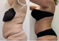 Appareil de liposuccion Vaser, laser diode 980nm+1470nm, lipolyse, endolaser, lifting du visage