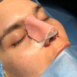 Férula nasal termoplástica <span class=keywords><strong>Aquaplast</strong></span> para rinoplastia Cirugía de fundición de nariz Inmovilización de rehabilitación de fracturas - Product Image 6