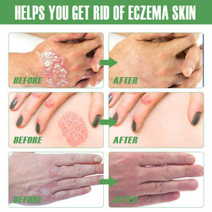 OEM Psoriasis <span class=keywords><strong>Eczema</strong></span> <span class=keywords><strong>Tratamiento</strong></span> Spray Athlete'foot Mano Tiña Dermatitis Antibacteriano Beriberi Anti Picazón Reparación Cuidado <span class=keywords><strong>DE</strong></span> LA PIEL - Product Image 3