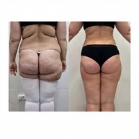 Vente flash - Appareil de liposuccion laser à diode portable 980 nm, machine de lipolyse laser 980, endolaser lifting