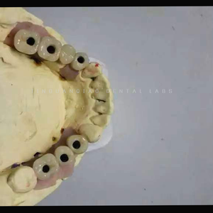 กล้องส่องทางไกลแบบครอบฟันรองรับฟันปลอม ivoclavar scheftner ผลิตตามสั่งไทเทเนียมห้องปฏิบัติการทันตกรรมจีน - Product Image 2