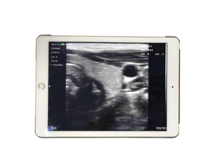 Sonda de Ultrassom Portátil Sem Fio com Array Linear, Imagem Colorida Doppler, Grau Clínico - Product Image 2